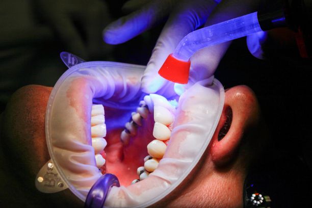 Dental Fillings